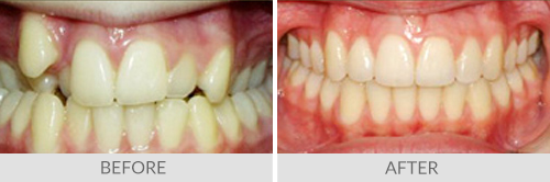 Before and After Braces - Alliance Orthodontics in Metro Atlanta, GA